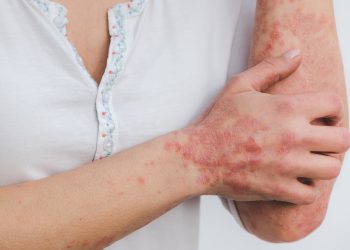 Qué es la psoriasis y cómo puede derivar en artritis psoriásica, una enfermedad crónica queafecta a la piel y las articulaciones