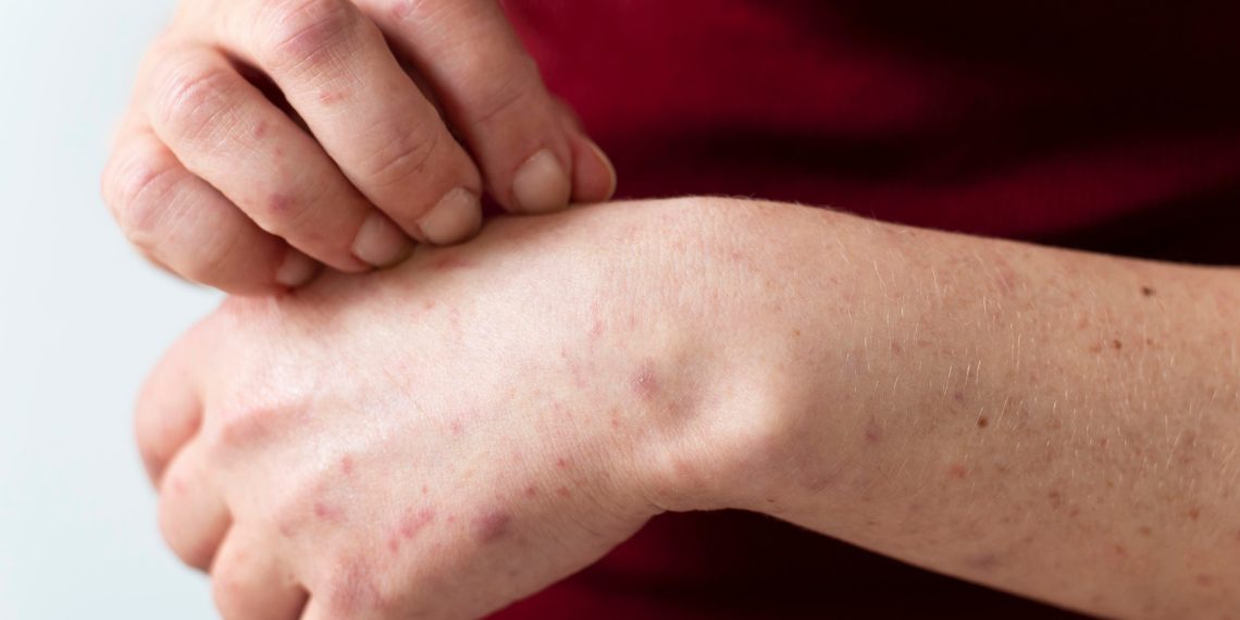 Alerta sanitaria por sarampión: una enfermedad de rápido contagio