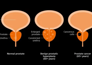 Así están evitando tratamientos innecesarios en hombres con cáncer de próstata