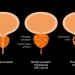Así están evitando tratamientos innecesarios en hombres con cáncer de próstata
