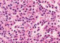 Especialistas advierten que Mieloma Múltiple sigue siendo diagnosticado tardíamente