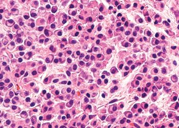 Especialistas advierten que Mieloma Múltiple sigue siendo diagnosticado tardíamente