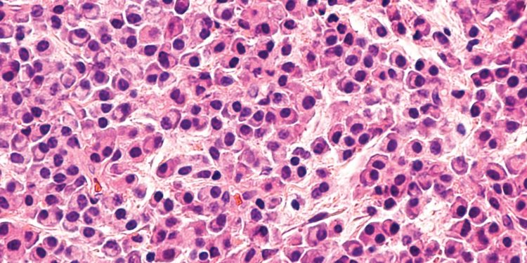 Especialistas advierten que Mieloma Múltiple sigue siendo diagnosticado tardíamente