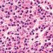 Especialistas advierten que Mieloma Múltiple sigue siendo diagnosticado tardíamente