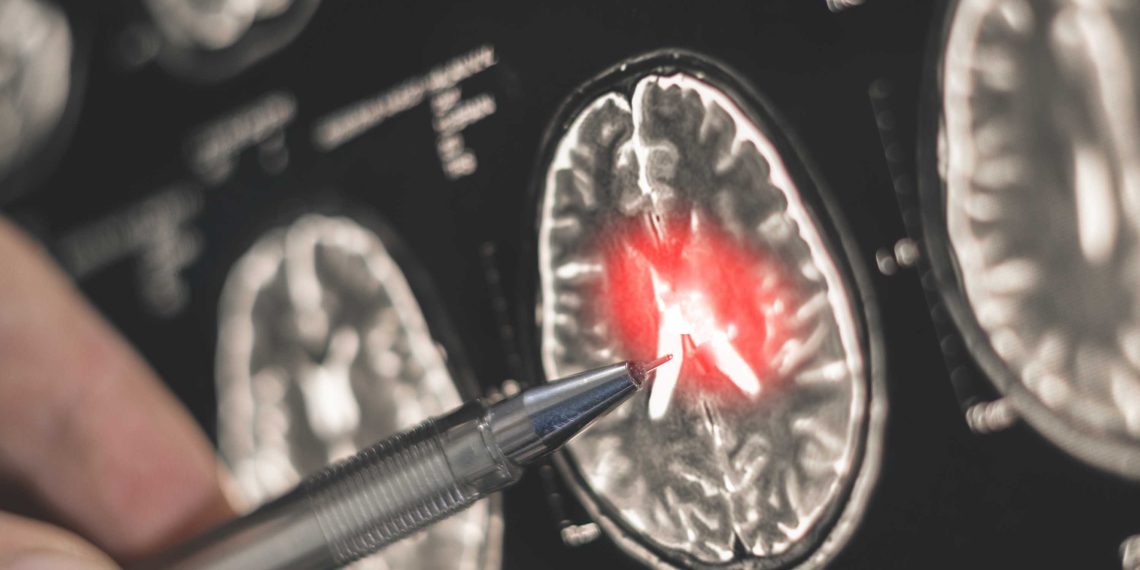 Doctora UCM desarrolló modelo que podría apoyar la detección temprana de Parkinson