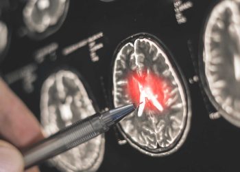 Doctora UCM desarrolló modelo que podría apoyar la detección temprana de Parkinson