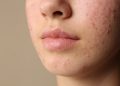 Acné hormonal en mujeres adultas: por qué los brotes pueden aparecer incluso después de los 30