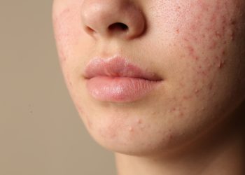 Acné hormonal en mujeres adultas: por qué los brotes pueden aparecer incluso después de los 30