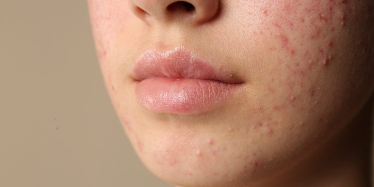 Acné hormonal en mujeres adultas: por qué los brotes pueden aparecer incluso después de los 30