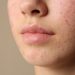 Acné hormonal en mujeres adultas: por qué los brotes pueden aparecer incluso después de los 30