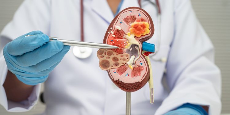 Cáncer de riñón: cuándo preocuparse y cuándo consultar a un médico