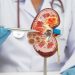 Cáncer de riñón: cuándo preocuparse y cuándo consultar a un médico