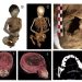 Estudio internacional revela que “Niño del Cerro El Plomo” murió en un ritual de sacrificio Inca y no de hipotermia